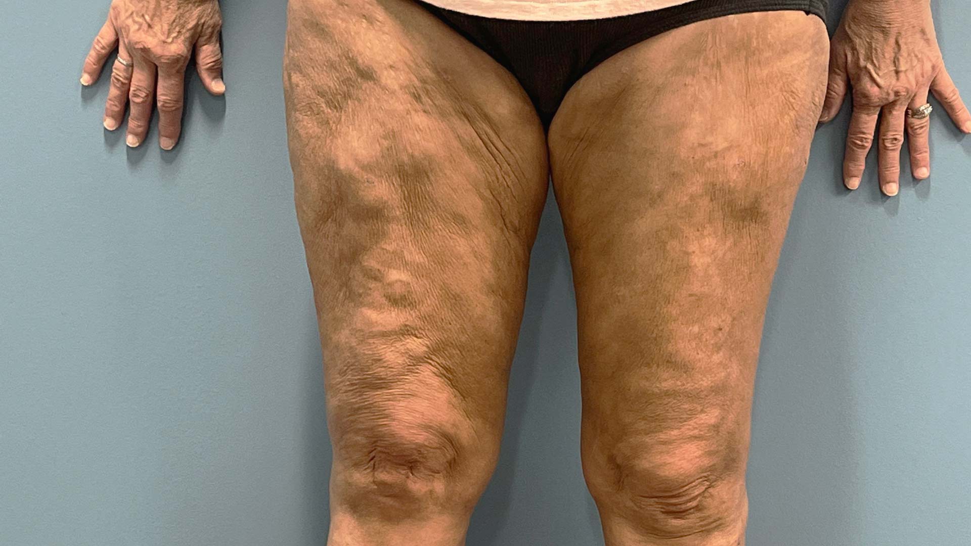 Lipödem erkennen: Früherkennung kann Schmerzen lindern